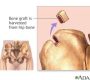 Bone Transplant (BT), commonly referred to as bone grafting, is a surgical procedure that replaces or repairs damaged bone using transplanted tissue or synthetic materials. It promotes bone regeneration, stabilizes fractures, and supports structural integrity in conditions like trauma, degenerative diseases, or post-dental extraction.