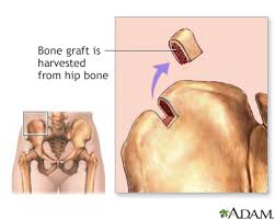 Bone Transplant (BT), commonly referred to as bone grafting, is a surgical procedure that replaces or repairs damaged bone using transplanted tissue or synthetic materials. It promotes bone regeneration, stabilizes fractures, and supports structural integrity in conditions like trauma, degenerative diseases, or post-dental extraction.