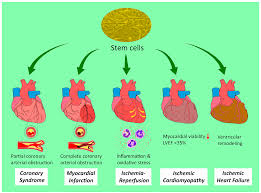 Intracoronary (IC) delivery of Cellular Therapy and Stem Cells involves administering these cells directly into the coronary arteries to treat cardiovascular diseases, particularly after myocardial infarction (MI). This approach aims to enhance cardiac repair by promoting tissue regeneration and reducing scar formation.