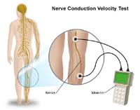 Nerve conduction studies (NCS) are diagnostic tests used to evaluate the function of peripheral nerves, which are located outside the central nervous system. These studies measure the speed and strength of electrical signals traveling through nerves, helping to diagnose conditions such as peripheral neuropathy and nerve compression syndromes.