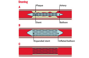 Angioplasty (Agp) is a minimally invasive procedure used to widen narrowed or blocked coronary arteries, improving blood flow to the heart. It involves using a balloon catheter to compress plaque against the artery walls, thereby restoring blood flow.