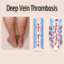 Deep Vein Thrombosis (DVT) is a serious medical condition where a blood clot forms in a deep vein, typically in the legs. It can lead to severe complications if not promptly treated, including pulmonary embolism (PE), which occurs when a clot breaks loose and travels to the lungs.