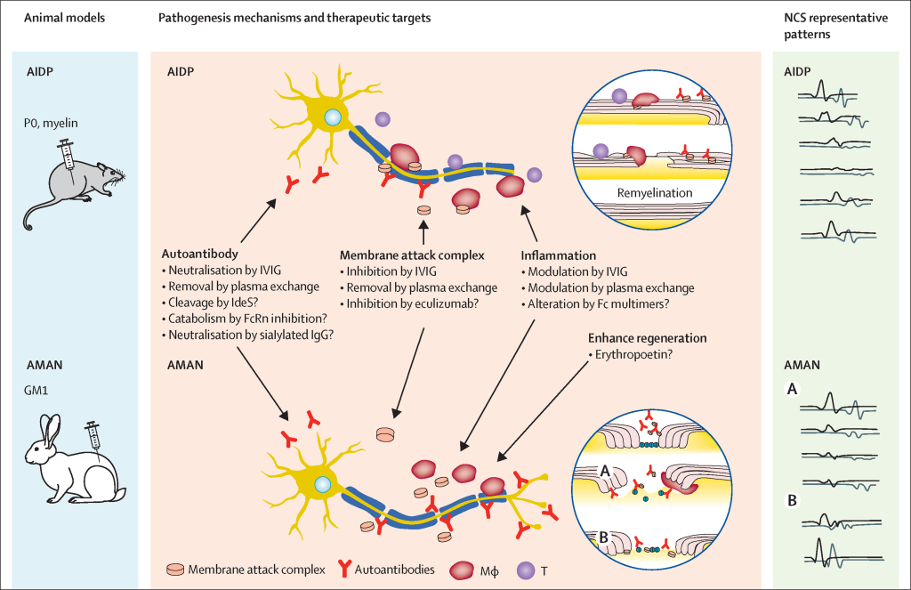  Cellular Therapy and Stem Cells for Guillain-Barré Syndrome (GBS):
The Role of Genetic and Environmental Factors in Guillain-Barré Syndrome (GBS)