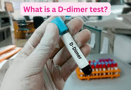 The D-dimer test (DDT) is a blood test used to detect the presence of D-dimer, a protein fragment produced when a blood clot breaks down. It is primarily used to help diagnose or rule out conditions related to blood clotting, such as deep vein thrombosis (DVT), pulmonary embolism (PE), and disseminated intravascular coagulation (DIC).