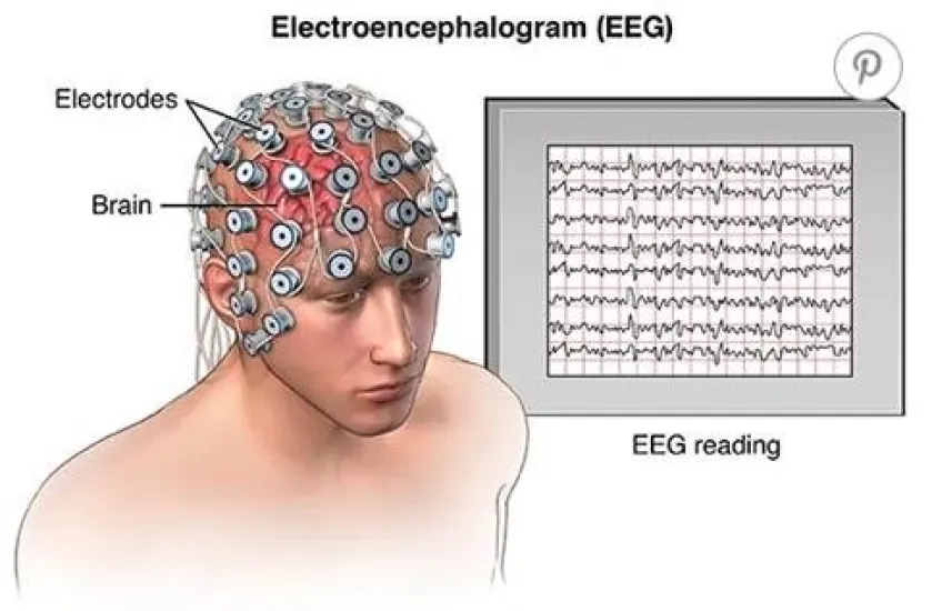 Electroencephalography (EEG) is a neurophysiological technique used to record the brain's spontaneous electrical activity156. During the procedure, small metal discs with thin wires, known as electrodes, are placed on the scalp to detect and record tiny electrical charges resulting from the activity of brain cells34. The EEG is typically non-invasive, and the electrodes are positioned using the International 10-20 system or its variations1. The electrical activity is amplified and displayed as a graph on a computer screen or printed on paper, which is then interpreted by a healthcare provider4.