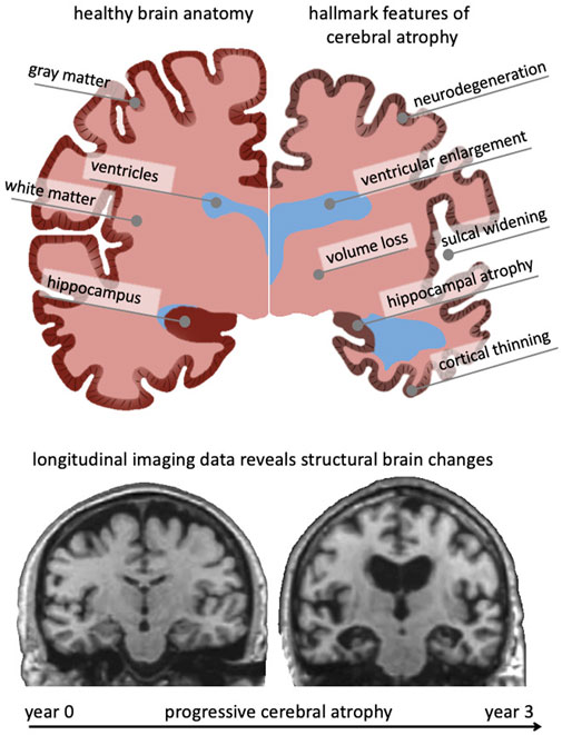 Brain atrophy (BA), also known as cerebral atrophy, is a condition characterized by a decrease in brain mass due to the loss of brain cells (neurons) and the connections between them467. It is not a disease itself, but rather a sign of underlying biological processes or diseases5. Brain atrophy can be focal, affecting specific areas of the brain, or generalized, affecting the entire brain267.