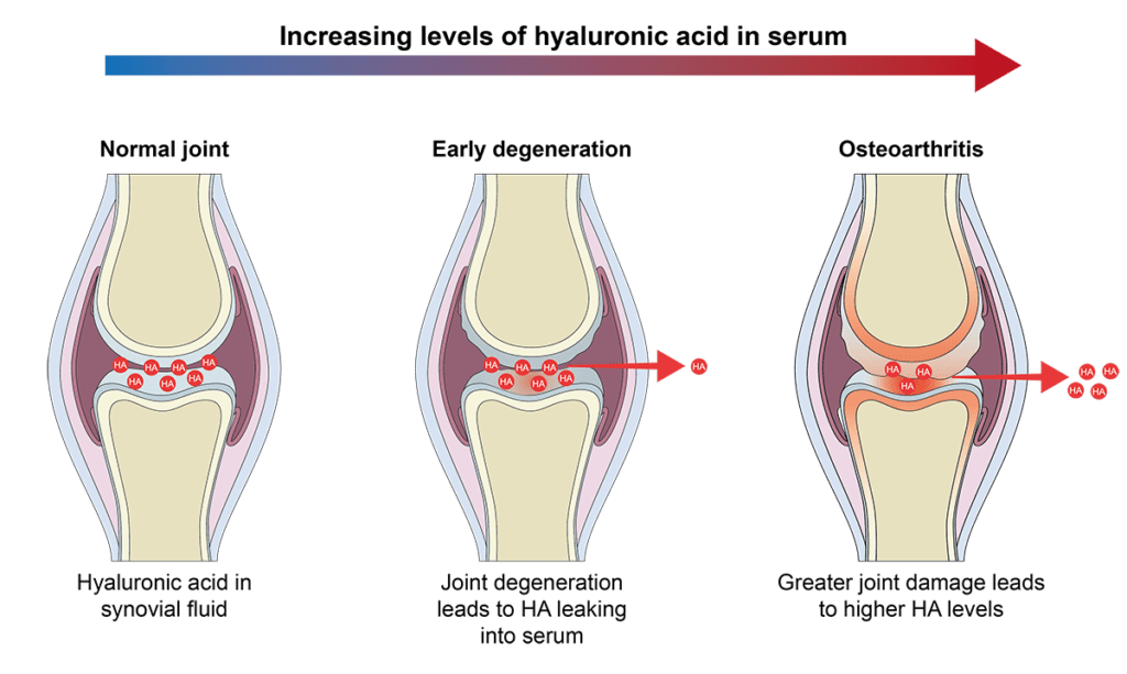 Degenerative joint disease (DJD) is a condition affecting the tissues of the joint that breaks down over time, also known as osteoarthritis (OA)23. It is characterized by pain, stiffness, and loss of function5. While historically considered a "wear and tear" condition, it is now recognized as a disease of the entire joint, including bone, cartilage, ligaments, fat, and the synovium2. DJD can affect any joint, but it typically affects the hands, knees, hips, lower back, and neck23. More than 50% of adults over the age of 65 are affected by degenerative joint disease5.