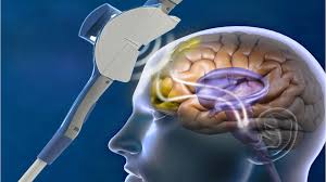 Transcranial Magnetic Stimulation (TMS) is a noninvasive neurostimulation technique that uses electromagnetic induction to modulate brain activity. Approved by the FDA for treating depression, TMS has diagnostic and therapeutic potential across neurology and psychiatry, though evidence for other conditions remains investigational.