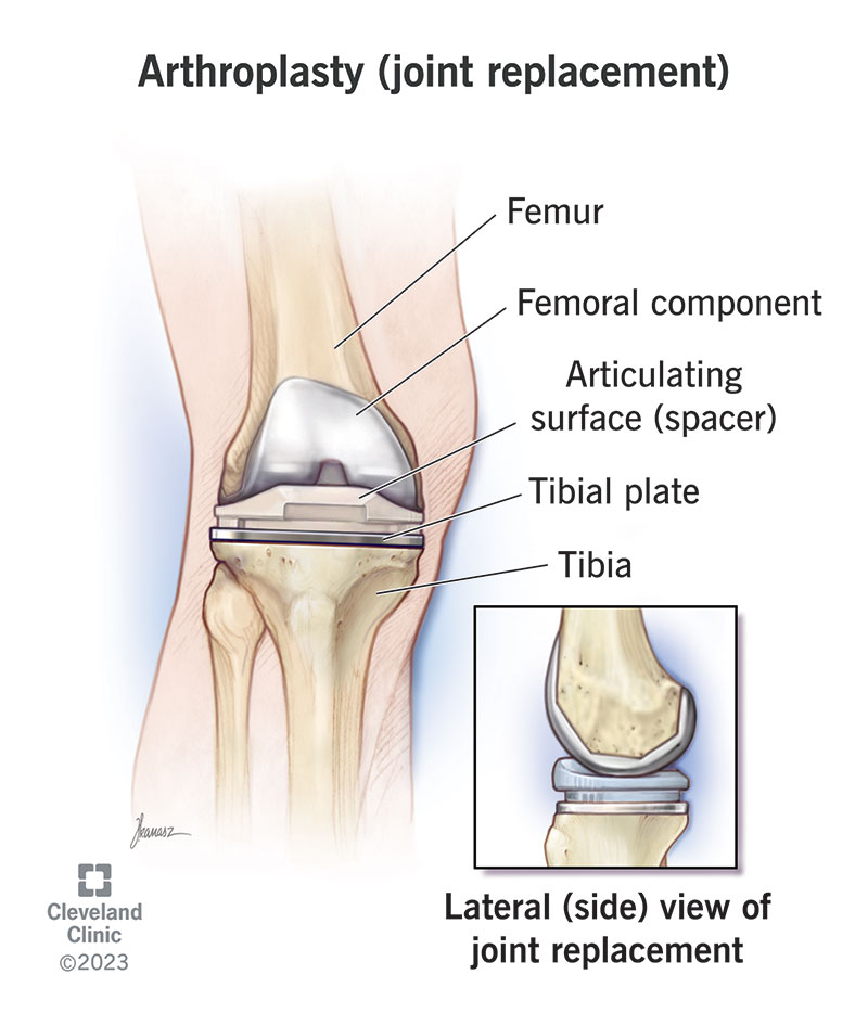 Joint replacement surgery, also known as arthroplasty, is a procedure where a damaged joint is replaced with an artificial joint (prosthesis) made of metal, plastic, or ceramic25. It's considered when severe joint pain or dysfunction isn't alleviated by less-invasive treatments3. The surgery aims to reduce pain, restore function, and improve quality of life57.