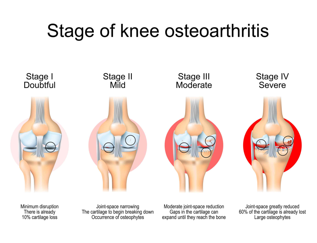 Cellular Therapy and Stem Cells for Knee Osteoarthritis (Knee OA) :
Knee osteoarthritis (OA) is a degenerative condition characterized by the gradual breakdown of cartilage in the knee joint, leading to pain, stiffness, and reduced function23. It is the most common form of arthritis in the knee, often resulting from age-related wear and tear, though injuries or other factors can also contribute12. While there is no cure, various treatments can manage symptoms and slow the condition's progression23.