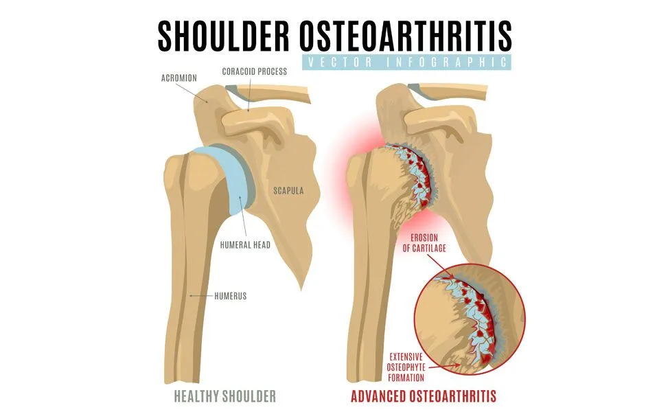 Shoulder osteoarthritis (OA) is a degenerative joint condition characterized by the breakdown of cartilage in the shoulder joint, leading to pain, stiffness, and reduced range of motion36. While shoulders are less susceptible to wear and tear compared to weight-bearing joints, longer lifespans and increased sports participation have contributed to rising numbers of shoulder problems earlier in life3.