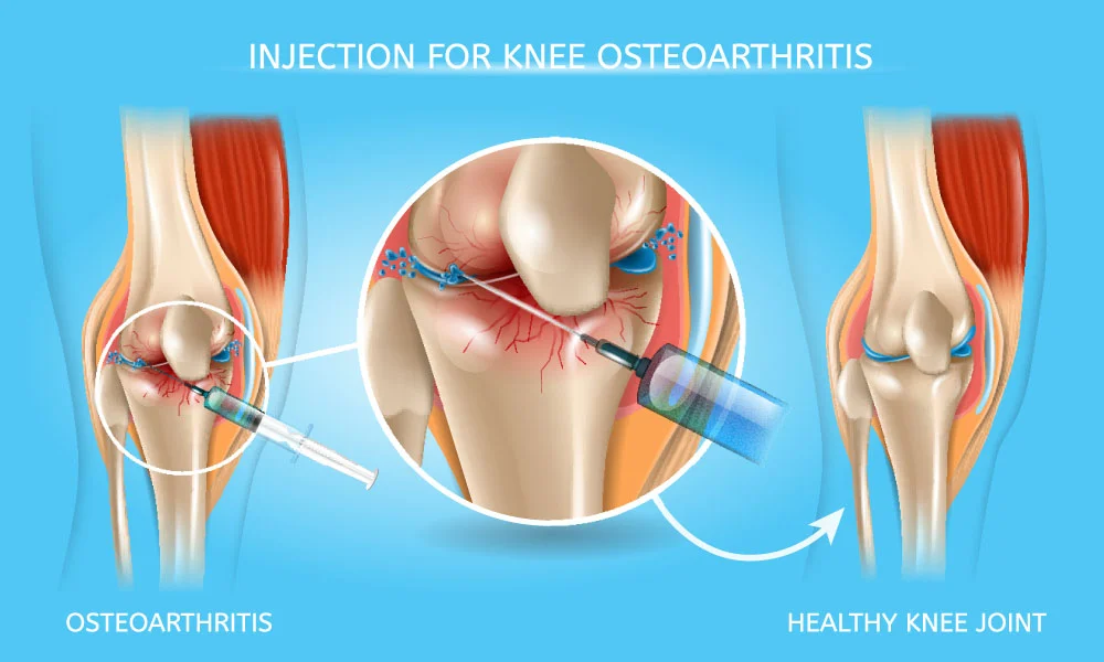 Intra-articular injection (IAI) of cellular therapy and stem cells is a treatment for knee osteoarthritis that aims to relieve pain, improve motor function, and stimulate cartilage regeneration34.