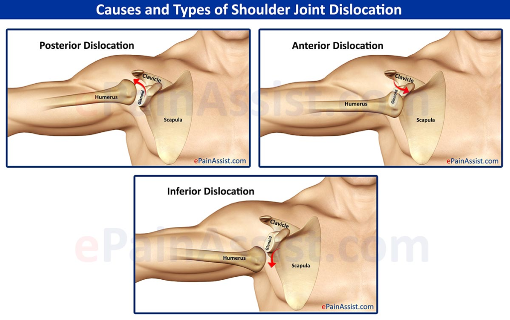 Shoulder Dislocations (SD) Functional Classification of  categorizes the severity of shoulder instability based on symptoms, frequency of dislocations, and limitations in daily activities. This system helps clinicians assess functional impairment and guide treatment decisions for patients with recurrent or chronic shoulder instability.