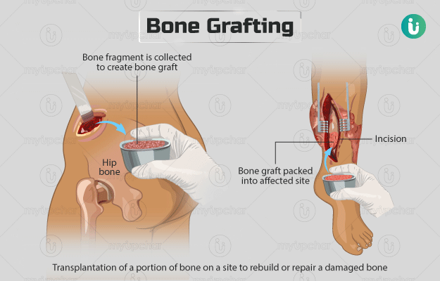 Bone Transplant (BT), commonly referred to as bone grafting, is a surgical procedure that replaces or repairs damaged bone using transplanted tissue or synthetic materials. It promotes bone regeneration, stabilizes fractures, and supports structural integrity in conditions like trauma, degenerative diseases, or post-dental extraction.