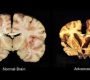 Brain atrophy (BA), also known as cerebral atrophy, is a condition characterized by a decrease in brain mass due to the loss of brain cells (neurons) and the connections between them467. It is not a disease itself, but rather a sign of underlying biological processes or diseases5. Brain atrophy can be focal, affecting specific areas of the brain, or generalized, affecting the entire brain267.