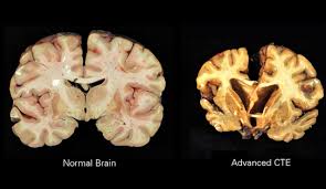 Brain atrophy (BA), also known as cerebral atrophy, is a condition characterized by a decrease in brain mass due to the loss of brain cells (neurons) and the connections between them467. It is not a disease itself, but rather a sign of underlying biological processes or diseases5. Brain atrophy can be focal, affecting specific areas of the brain, or generalized, affecting the entire brain267.