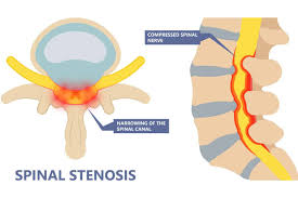 The spinal canal, also known as the vertebral canal, is an elongated body cavity within the vertebral column that houses the spinal cord, spinal nerve roots, and associated structures. It extends from the foramen magnum at the base of the skull to the sacral hiatus in the lower back.