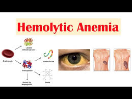 Hemolytic anemia (HA) is a condition in which red blood cells (RBCs) are destroyed faster than the body can replace them, leading to a deficiency of healthy red blood cells and hemoglobin, which are crucial for oxygen delivery throughout the body158. The destruction of red blood cells is called hemolysis134. Hemolytic anemia accounts for 5% of all existing anemias1. It can be acquired or inherited, and the severity and duration can vary34.