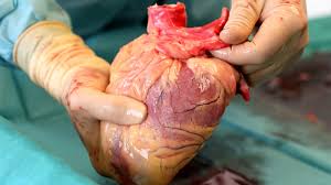 Heart transplantation is a life-saving surgical procedure for patients with end-stage heart failure. It involves replacing a diseased heart with a healthy donor heart. The process is complex and requires careful evaluation, preparation, and post-operative care.