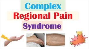 Complex Regional Pain Syndrome (CRPS) is a chronic pain condition that most often affects an arm or a leg, usually developing after an injury, surgery, stroke, or heart attack. The pain experienced is typically severe, continuous, and disproportionate to the initial injury.