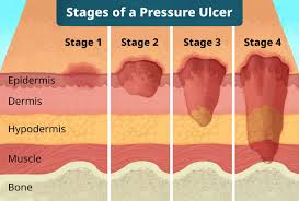 Pressure ulcers (PU)-also known as bedsores, pressure sores, decubitus ulcers, or pressure injuries-are localized injuries to the skin and underlying tissue, typically occurring over bony prominences as a result of prolonged pressure, often combined with shear, friction, or moisture17. These ulcers are a significant concern in immobile or bedridden individuals, such as those with paralysis, chronic illness, or after surgery256.