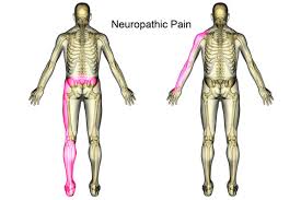 Neuropathic pain (NP) is a complex, chronic pain condition that arises from damage or disease affecting the somatosensory nervous system, which includes peripheral nerves, the spinal cord, and the brain128. Unlike nociceptive pain, which results from tissue injury, neuropathic pain is due to abnormal processing of pain signals by the nervous system itself.