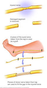 Nerve trauma refers to injury to peripheral nerves caused by physical damage such as cuts, compression, stretching, or blunt force. These injuries disrupt nerve function, leading to sensory, motor, and autonomic symptoms depending on the nerve involved and severity of damage.