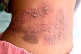 Shingles (Herpes Zoster) is a viral infection caused by the reactivation of the varicella-zoster virus-the same virus responsible for chickenpox. After a person recovers from chickenpox, the virus remains dormant in nerve tissues and can reactivate years later as shingles.