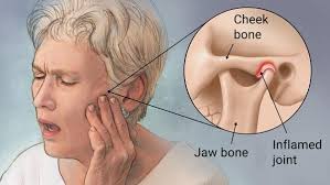 Temporomandibular Joint Disorders (TMJD or TMD) are a group of conditions affecting the temporomandibular joints (TMJs)-the joints connecting the lower jaw (mandible) to the skull-and the muscles controlling jaw movement. These disorders cause pain, dysfunction, and sometimes restricted movement of the jaw.