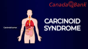 Carcinoid syndrome is a rare condition caused by the secretion of serotonin and other vasoactive substances from carcinoid tumors, a type of neuroendocrine tumor (NET) most commonly found in the gastrointestinal tract or lungs. It typically occurs in patients with advanced tumors that have metastasized to the liver, allowing these substances to bypass liver metabolism and enter systemic circulation.