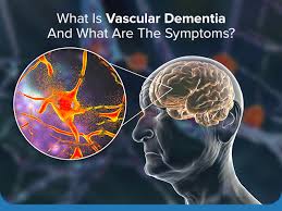 Vascular dementia is a type of dementia caused by reduced or impaired blood flow to the brain, leading to brain damage that affects reasoning, planning, judgment, memory, and other cognitive functions. It is the second most common form of dementia after Alzheimer's disease.
