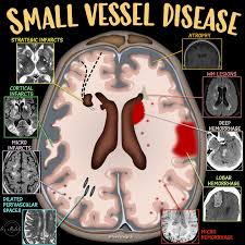 Small vessel disease (SVD) refers to pathological processes affecting the small arteries, arterioles, capillaries, and venules, leading to impaired blood flow and tissue damage. It is a systemic condition impacting organs with rich microvascular networks, especially the brain, heart, kidneys, and retina.
