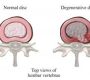 Degenerative Spine Disease (DSD) is a broad term encompassing conditions that result from the gradual deterioration of the spine’s structure and function, most commonly due to aging but also from tumors, infections, or arthritis17. The spine consists of vertebrae and intervertebral discs that provide stability and flexibility. As these structures degenerate, they can cause pain, nerve dysfunction, and reduced mobility.