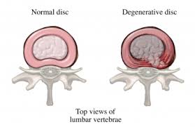 Degenerative Spine Disease (DSD) is a broad term encompassing conditions that result from the gradual deterioration of the spine’s structure and function, most commonly due to aging but also from tumors, infections, or arthritis17. The spine consists of vertebrae and intervertebral discs that provide stability and flexibility. As these structures degenerate, they can cause pain, nerve dysfunction, and reduced mobility.