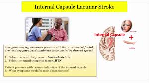 Lacunar infarcts are small, deep brain infarcts typically measuring 2–20 mm in diameter, resulting from occlusion of a single small perforating artery supplying subcortical regions such as the deep white matter, basal ganglia, thalamus, internal capsule, or pons13. They are a hallmark of cerebral small vessel disease (SVD) and contribute significantly to stroke and vascular cognitive impairment.
