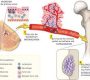 Bone metastases occur when cancer cells spread from their original site to the bones. This is a common and serious complication of many cancers, especially breast, prostate, lung, kidney, thyroid cancers, lymphoma, and multiple myeloma1236. Bone metastases can develop in any bone but are most frequently found in the spine, pelvis, and long bones such as the femur1.