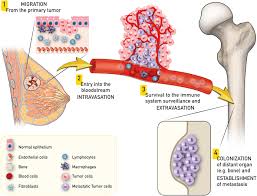 Bone metastases occur when cancer cells spread from their original site to the bones. This is a common and serious complication of many cancers, especially breast, prostate, lung, kidney, thyroid cancers, lymphoma, and multiple myeloma1236. Bone metastases can develop in any bone but are most frequently found in the spine, pelvis, and long bones such as the femur1.