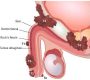 Penile cancer (PeCa) is a rare malignancy that primarily affects men over the age of 50, with the average diagnosis age around 60–68 years. It arises when abnormal cells in the penis grow uncontrollably, often linked to several risk factors.