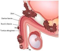 Penile cancer (PeCa) is a rare malignancy that primarily affects men over the age of 50, with the average diagnosis age around 60–68 years. It arises when abnormal cells in the penis grow uncontrollably, often linked to several risk factors.