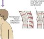 Spinal cord compression (SCC) occurs when pressure is applied to the spinal cord by various causes, leading to impaired nerve function. This pressure can develop suddenly or gradually and affects the transmission of signals between the brain and the rest of the body, causing a range of neurological symptoms.