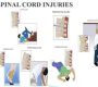 Spinal cord infarction, also known as ischemic myelopathy or spinal stroke, is a rare but serious condition caused by interruption of blood flow to the spinal cord, leading to ischemia and subsequent tissue death. It most commonly results from ischemia originating in an extravertebral artery supplying the spinal cord, such as branches from the aorta.