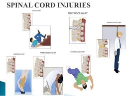Spinal cord infarction, also known as ischemic myelopathy or spinal stroke, is a rare but serious condition caused by interruption of blood flow to the spinal cord, leading to ischemia and subsequent tissue death. It most commonly results from ischemia originating in an extravertebral artery supplying the spinal cord, such as branches from the aorta.
