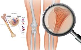 Bone marrow failure (BMF) is a condition in which the bone marrow cannot produce adequate amounts of one or more types of blood cells-red blood cells, white blood cells, or platelets. This results in anemia, increased risk of infection, and bleeding or bruising due to low platelets126.
