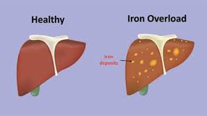 Iron Overload (IO), also known as hemochromatosis, is a condition in which the body accumulates excessive iron. Since the body has no natural way to excrete excess iron, it builds up in organs over time, potentially causing serious damage168.