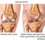 Joint Degeneration (JDG), most commonly referred to as osteoarthritis (OA) or degenerative joint disease, is a progressive condition characterized by the breakdown of articular cartilage and changes in surrounding joint structures, ultimately leading to pain, stiffness, reduced mobility, and functional impairment2348.