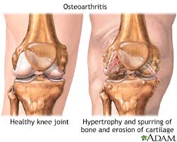 Joint Degeneration (JDG), most commonly referred to as osteoarthritis (OA) or degenerative joint disease, is a progressive condition characterized by the breakdown of articular cartilage and changes in surrounding joint structures, ultimately leading to pain, stiffness, reduced mobility, and functional impairment2348.