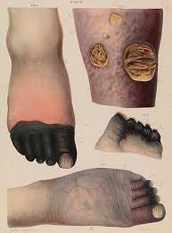 Foot gangrene is the death of tissue in the foot due to a lack of blood supply, severe infection, or both. It is a medical emergency that can lead to limb loss or death if not treated promptly1246.