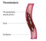 Thrombolysis, also known as fibrinolytic therapy, is a medical treatment used to dissolve dangerous blood clots (thrombi) that have formed in blood vessels. This therapy aims to restore blood flow, prevent tissue and organ damage, and is often used as an emergency intervention in conditions like heart attack (ST-elevation myocardial infarction), acute ischemic stroke, and severe pulmonary embolism1467.