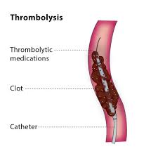 Thrombolysis, also known as fibrinolytic therapy, is a medical treatment used to dissolve dangerous blood clots (thrombi) that have formed in blood vessels. This therapy aims to restore blood flow, prevent tissue and organ damage, and is often used as an emergency intervention in conditions like heart attack (ST-elevation myocardial infarction), acute ischemic stroke, and severe pulmonary embolism1467.