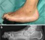 Charcot joint, also known as neuropathic arthropathy or Charcot neuroarthropathy, is a progressive, destructive joint disorder characterized by fragmentation, dislocation, and deformity of bones and joints. It occurs in the setting of peripheral neuropathy, where loss of protective sensation leads to repeated trauma and inflammation unnoticed by the patient.